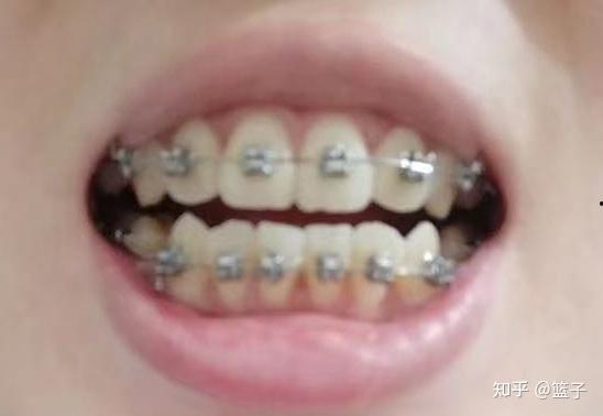 成人线拔牙齿视频,真实视频带你直观体验